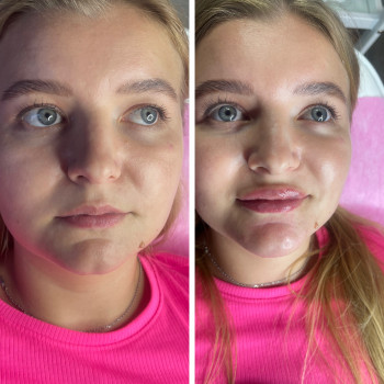 Контурна пластика губ, підборіддя