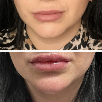 Контурна пластика губ