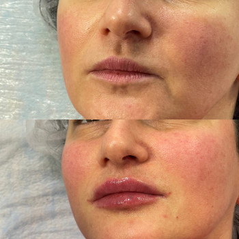 Контурна пластика губ