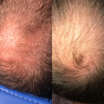 Мезотерапія волосся + плазма