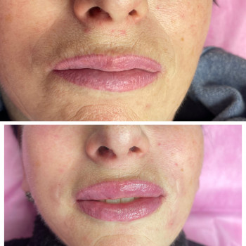 Контурна пластика губ