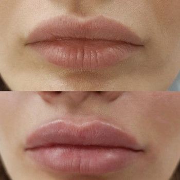 Контурна пластика губ
                    Косметологический центр  Ужгород