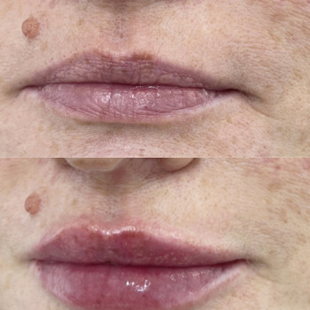 Контурна пластика губ
                    Косметологический центр  Ужгород