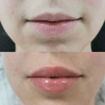 Контурна пластика губ
                    Косметологический центр  Ужгород