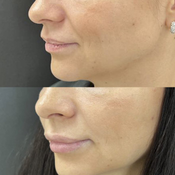 Контурна пластика губ
                    Косметологический центр  Ужгород