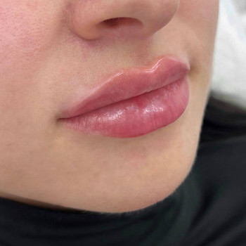 Контурна пластика губ
                    Косметологический центр  Ужгород