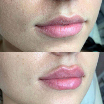 Контурна пластика губ
                    Косметологический центр  Ужгород