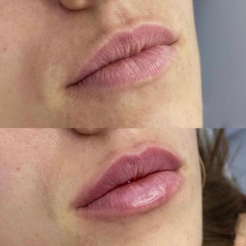 Контурна пластика губ
                    Косметологический центр  Ужгород