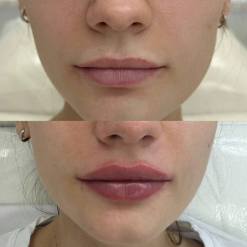 Контурна пластика губ
                    Косметологический центр  Ужгород