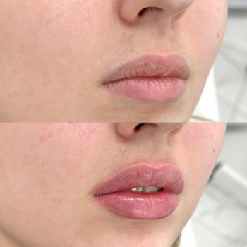 Контурна пластика губ
                    Косметологический центр  Ужгород