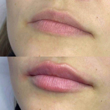 Контурна пластика губ
                    Косметологический центр  Ужгород