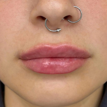 Контурна пластика губ
                    Косметологический центр  Ужгород