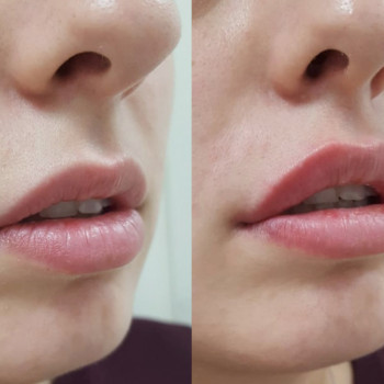 Контурна пластика губ
                    Косметологический центр  Ужгород