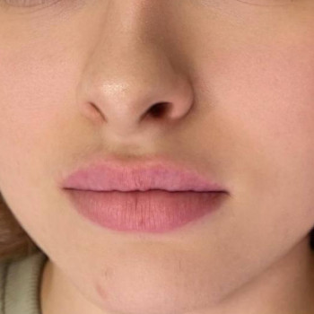 Контурна пластика губ
                    Косметологический центр  Ужгород