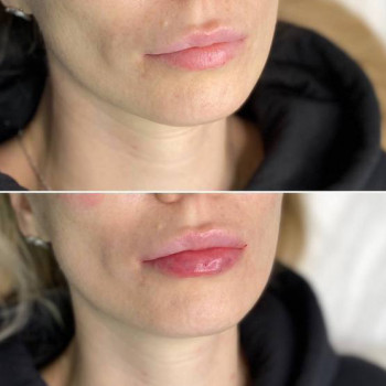 Контурна пластика губ
                    Косметологический центр  Ужгород