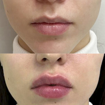 Контурна пластика губ
                    Косметологический центр  Ужгород