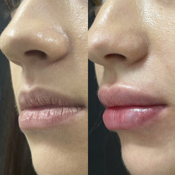 Контурна пластика губ
                    Косметологический центр  Ужгород