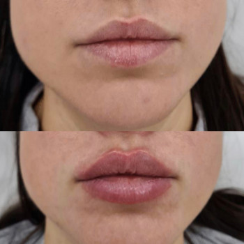 Контурна пластика губ
                    Косметологический центр  Ужгород