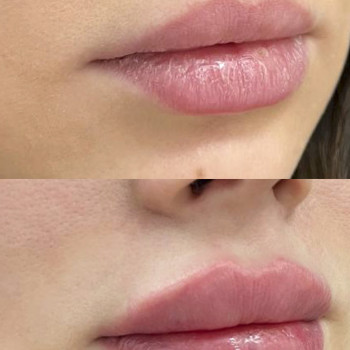 Контурна пластика губ
                    Косметологический центр  Ужгород