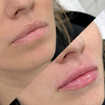 Контурна пластика губ
                    Косметологический центр  Ужгород