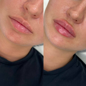 Контурна пластика губ
                    Косметологический центр  Ужгород