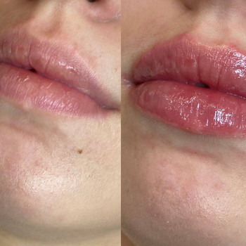 Контурна пластика губ
                    Косметологический центр  Ужгород