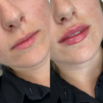 Контурна пластика губ
                    Косметологический центр  Ужгород