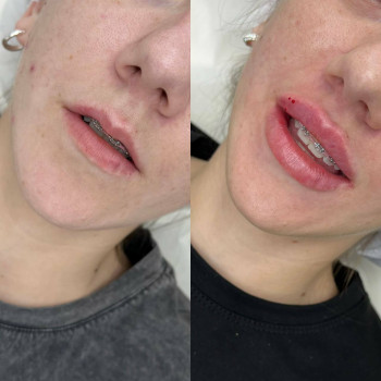 Контурна пластика губ
                    Косметологический центр  Ужгород