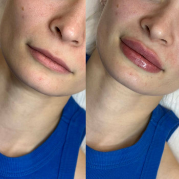 Контурна пластика губ
                    Косметологический центр  Ужгород