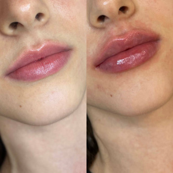 Контурна пластика губ
                    Косметологический центр  Ужгород