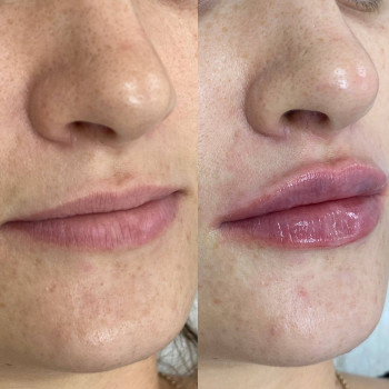 Контурна пластика губ
                    Косметологический центр  Ужгород