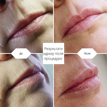 Контурна пластика губ
                    Косметологический центр  Ужгород