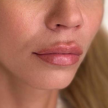 Контурна пластика губ
                    Косметологический центр  Ужгород