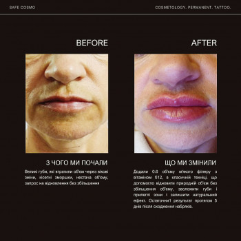 Контурна пластика губ
                    Косметологический центр  Ужгород