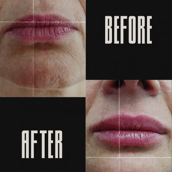 Контурна пластика губ
                    Косметологический центр  Ужгород