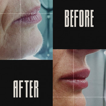 Контурна пластика губ
                    Косметологический центр  Ужгород