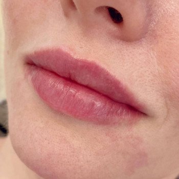 Контурна пластика губ
                    Косметологический центр  Ужгород