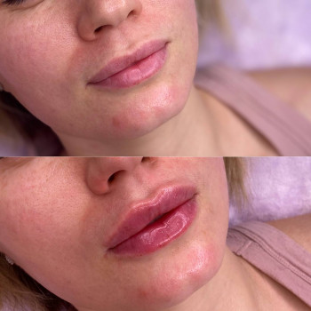 Контурна пластика губ
                    Косметологический центр  Ужгород