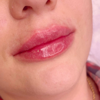 Контурна пластика губ
                    Косметологический центр  Ужгород