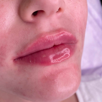 Контурна пластика губ
                    Косметологический центр  Ужгород