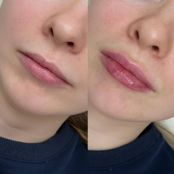 Контурна пластика губ
                    Косметологический центр  Ужгород