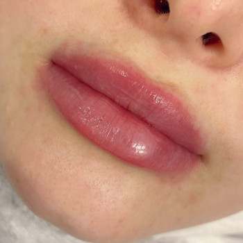 Контурна пластика губ
                    Косметологический центр  Ужгород