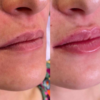 Контурна пластика губ
                    Косметологический центр  Ужгород