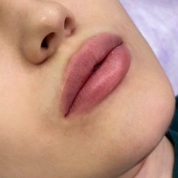 Контурна пластика губ
                    Косметологический центр  Ужгород