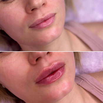 Контурна пластика губ
                    Косметологический центр  Ужгород