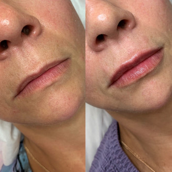 Контурна пластика губ
                    Косметологический центр  Ужгород