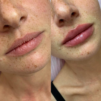 Контурна пластика губ
                    Косметологический центр  Ужгород