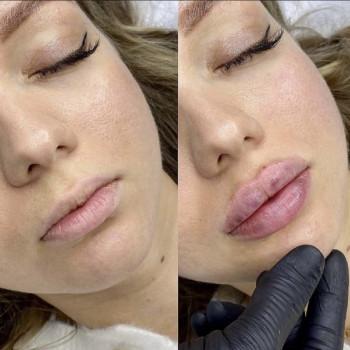 Контурна пластика губ
                    Косметологический центр  Ужгород