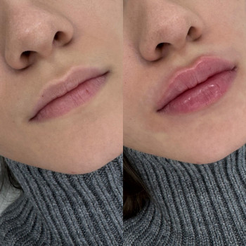 Контурна пластика губ
                    Косметологический центр  Ужгород