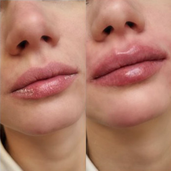 Контурна пластика губ
                    Косметологический центр  Ужгород